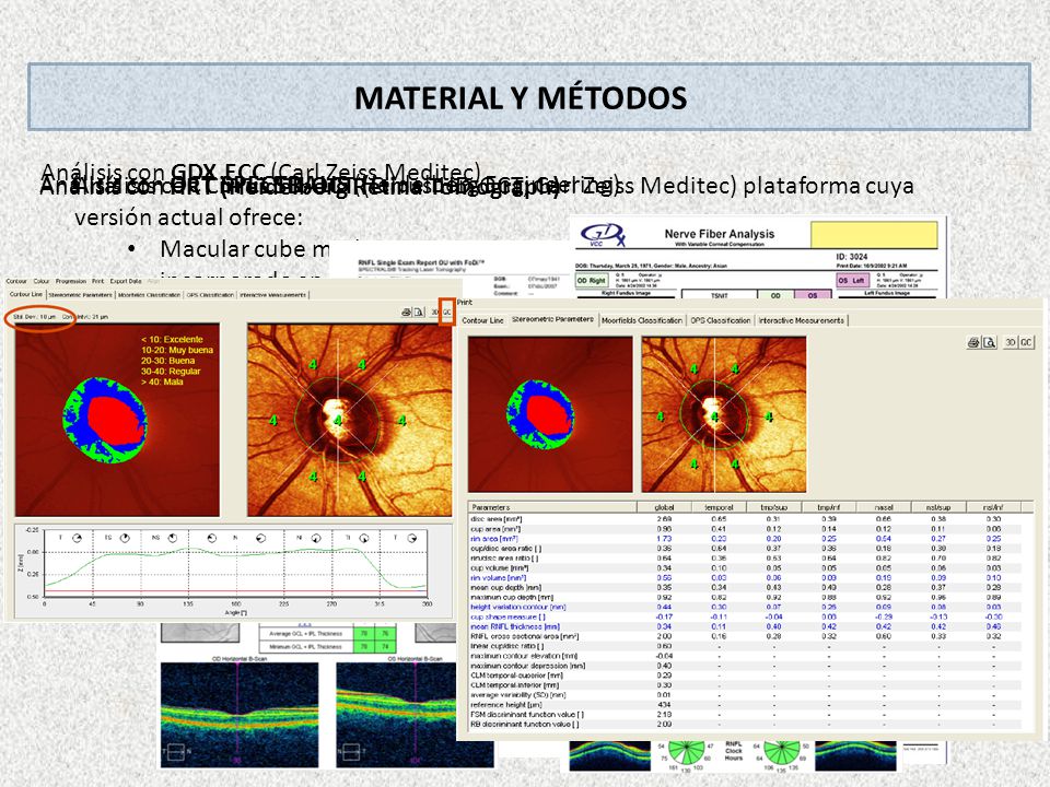 MATERIAL Y MÉTODOS Análisis con GDX ECC (Carl Zeiss Meditec)
