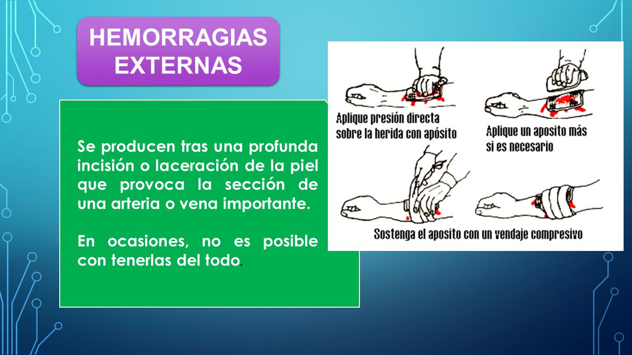 HEMORRAGIAS EXTERNAS Se producen tras una profunda incisión o laceración de la piel que provoca la sección de una arteria o vena importante.