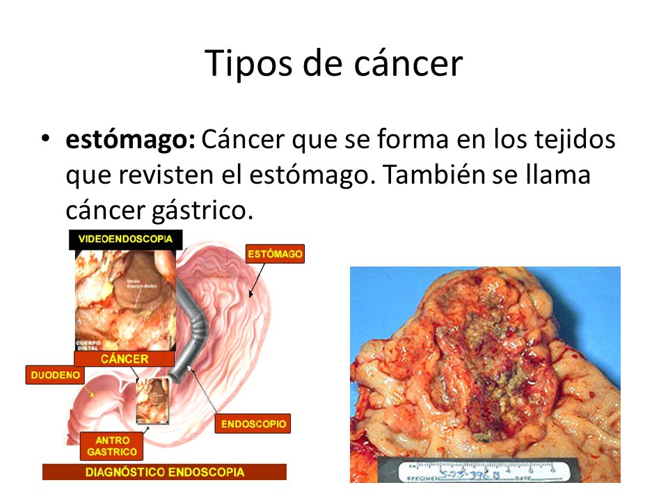 Tipos de cáncer estómago: Cáncer que se forma en los tejidos que revisten el estómago.