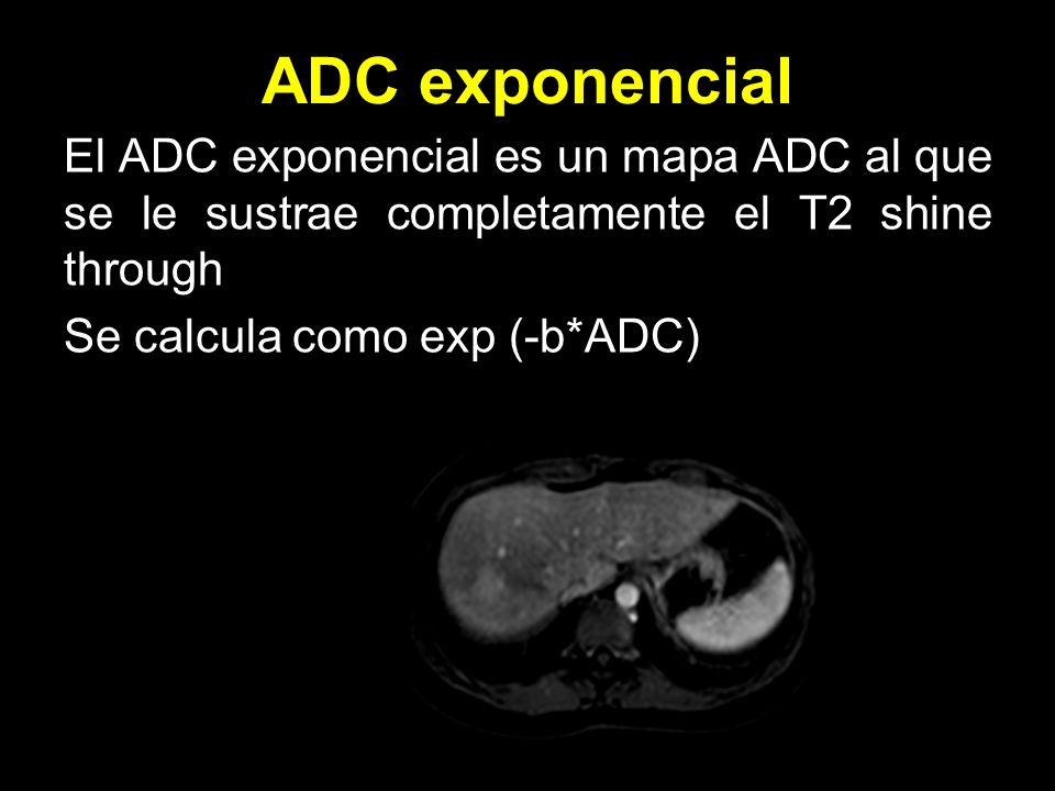 ADC exponencial El ADC exponencial es un mapa ADC al que se le sustrae completamente el T2 shine through Se calcula como exp (-b*ADC)