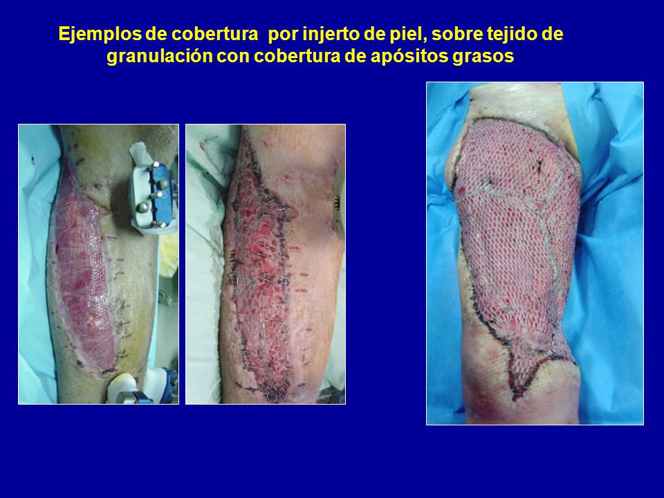 Ejemplos de cobertura por injerto de piel, sobre tejido de granulación con cobertura de apósitos grasos