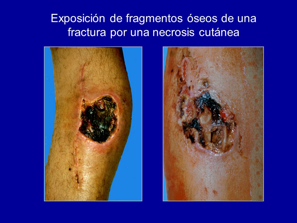 Exposición de fragmentos óseos de una fractura por una necrosis cutánea