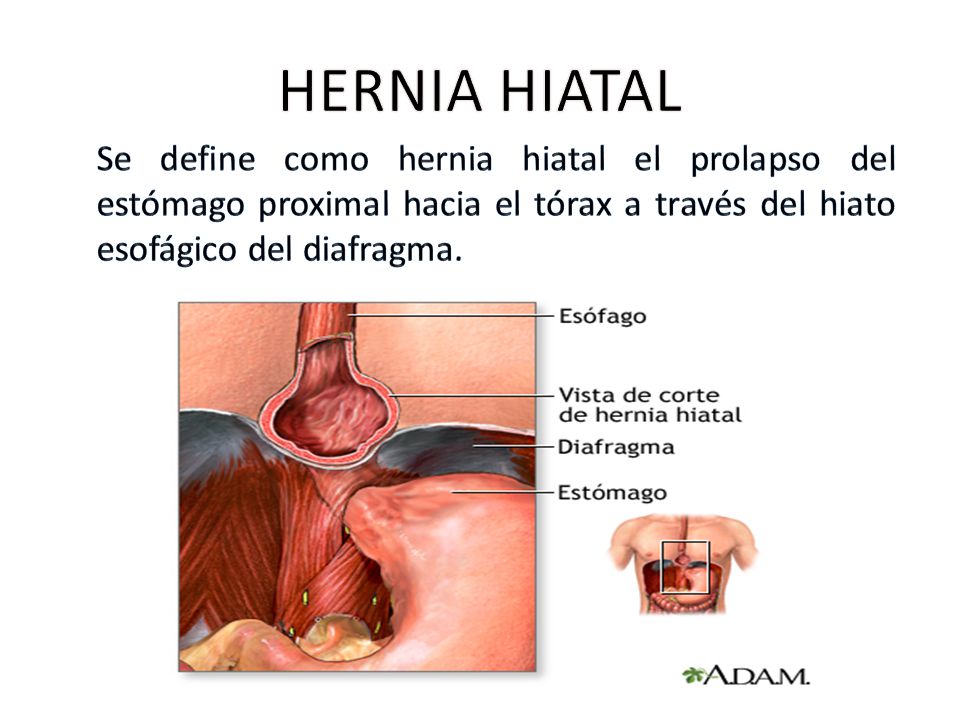 HERNIA HIATAL Se define como hernia hiatal el prolapso del estómago proximal hacia el tórax a través del hiato esofágico del diafragma.