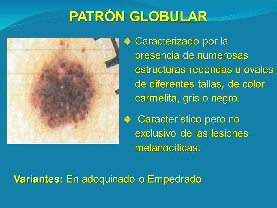 PATRÓN GLOBULAR Caracterizado por la presencia de numerosas estructuras redondas u ovales de diferentes tallas, de color carmelita, gris o negro.