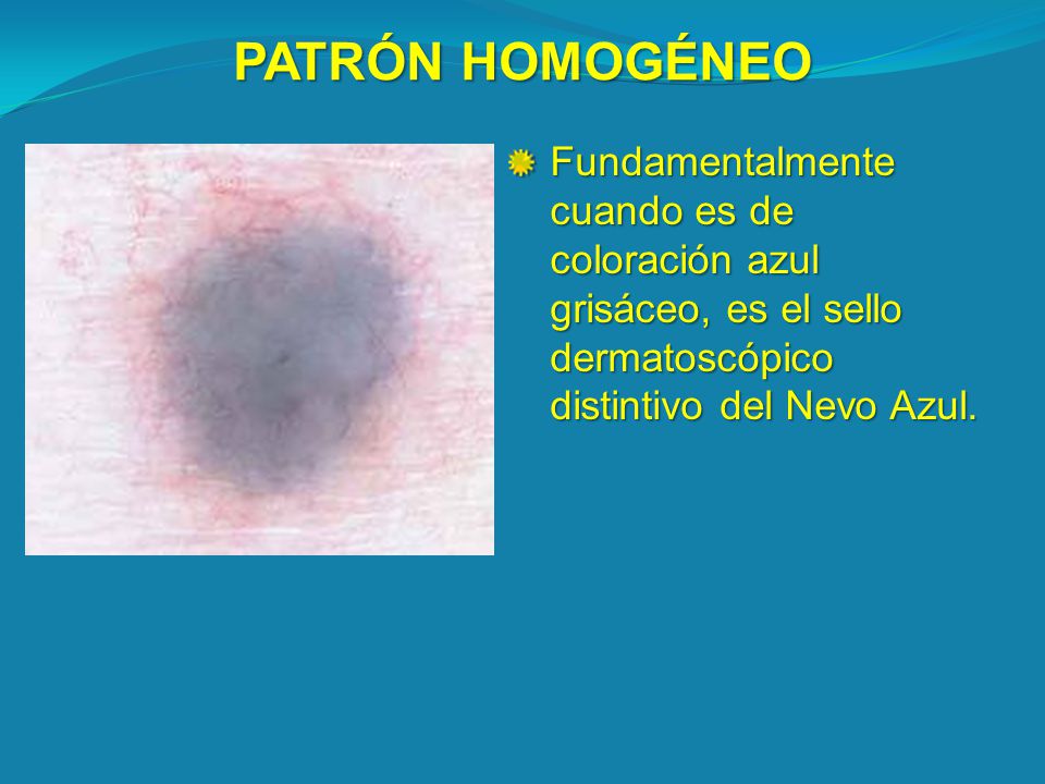 PATRÓN HOMOGÉNEO Fundamentalmente cuando es de coloración azul grisáceo, es el sello dermatoscópico distintivo del Nevo Azul.