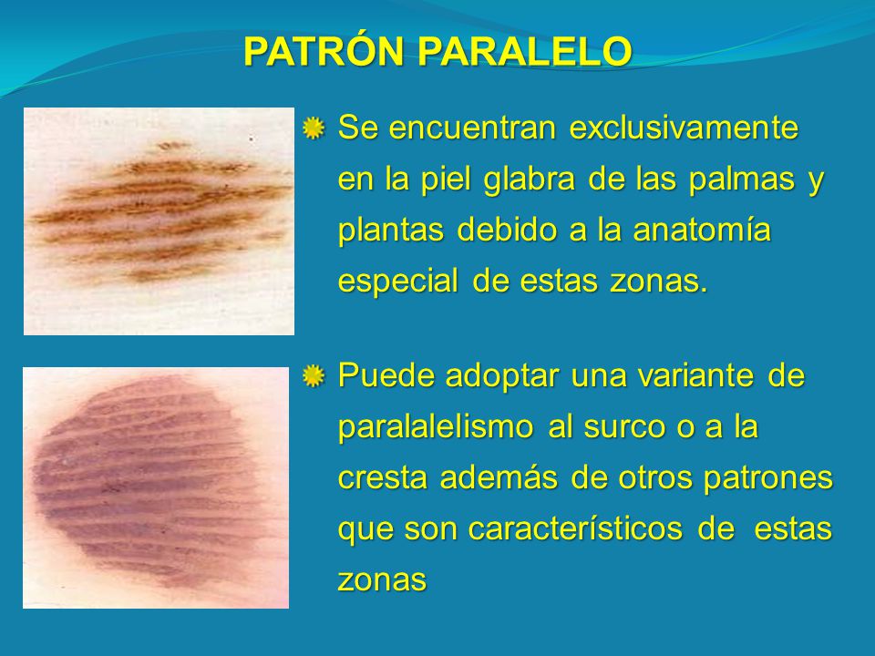 PATRÓN PARALELO Se encuentran exclusivamente en la piel glabra de las palmas y plantas debido a la anatomía especial de estas zonas.