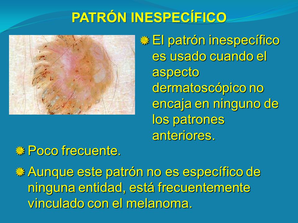 PATRÓN INESPECÍFICO El patrón inespecífico es usado cuando el aspecto dermatoscópico no encaja en ninguno de los patrones anteriores.