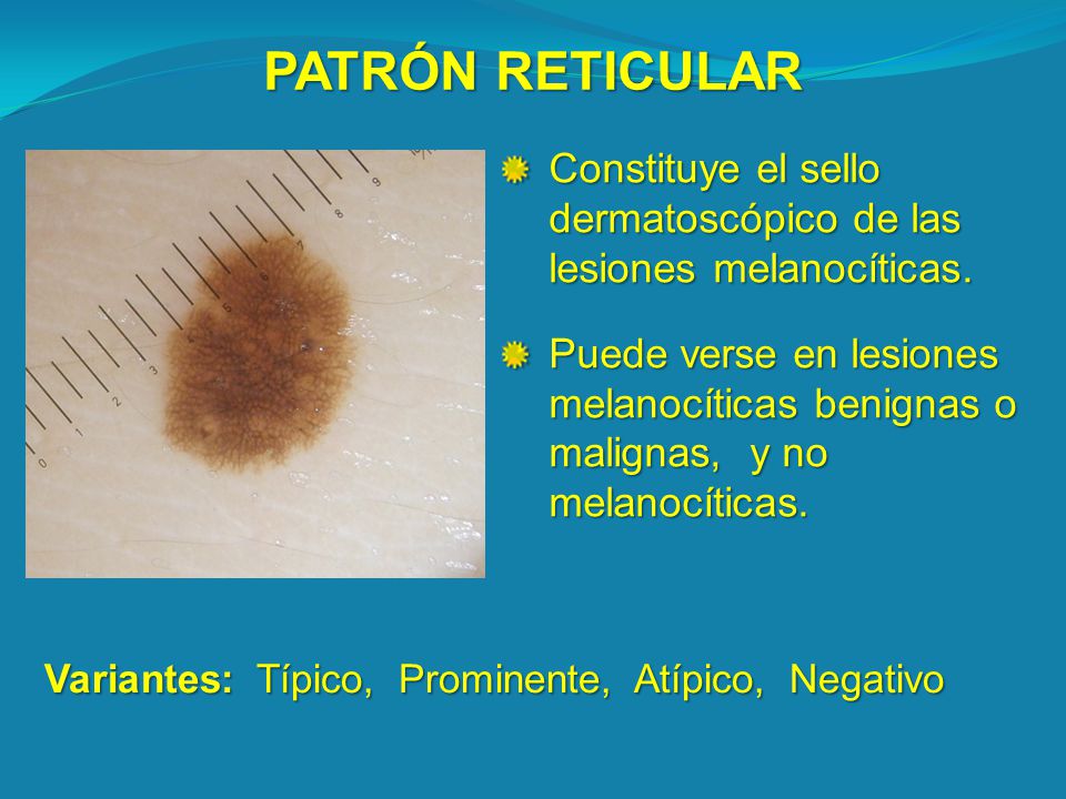 PATRÓN RETICULAR Constituye el sello dermatoscópico de las lesiones melanocíticas.