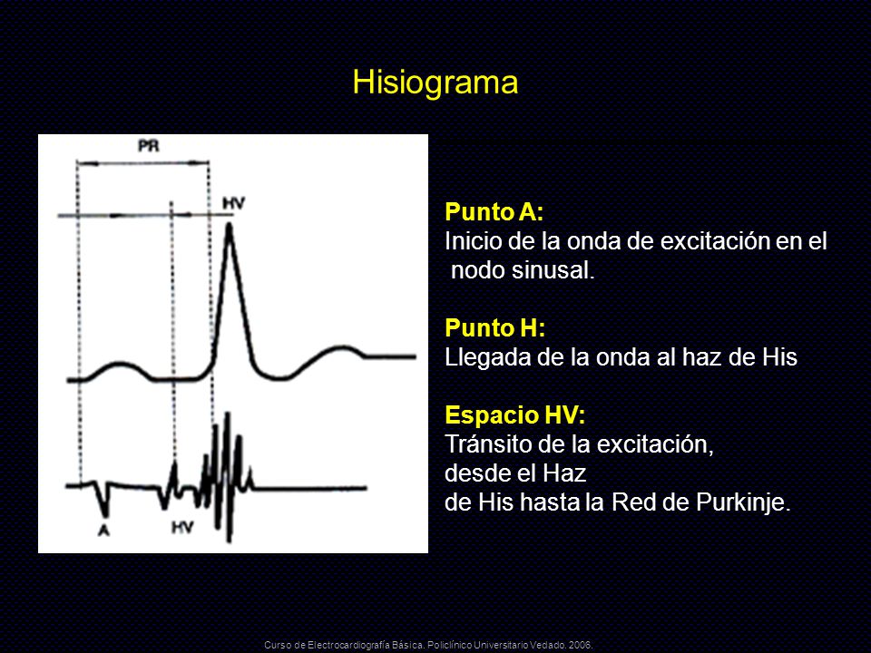 Hisiograma Punto A: Inicio de la onda de excitación en el