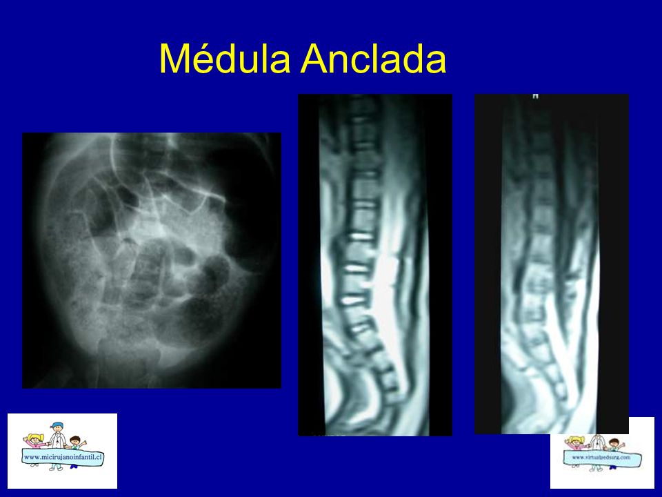 Médula Anclada
