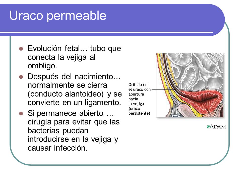 Uraco permeable Evolución fetal… tubo que conecta la vejiga al ombligo.
