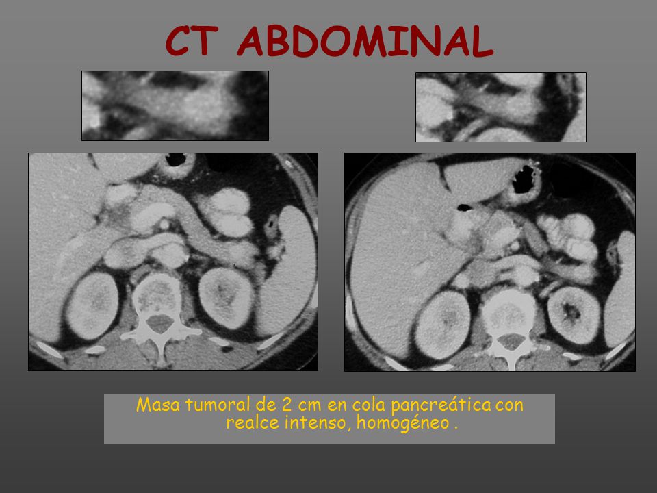CT ABDOMINAL Masa tumoral de 2 cm en cola pancreática con realce intenso, homogéneo .