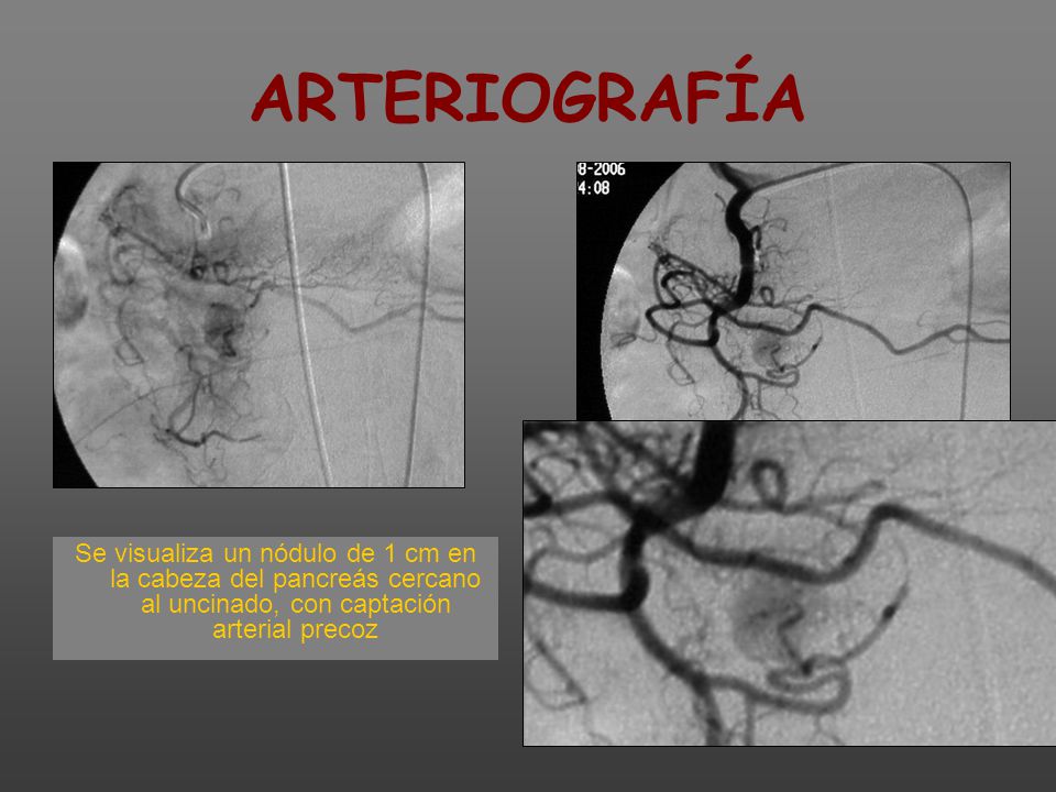 ARTERIOGRAFÍA Se visualiza un nódulo de 1 cm en la cabeza del pancreás cercano al uncinado, con captación arterial precoz.