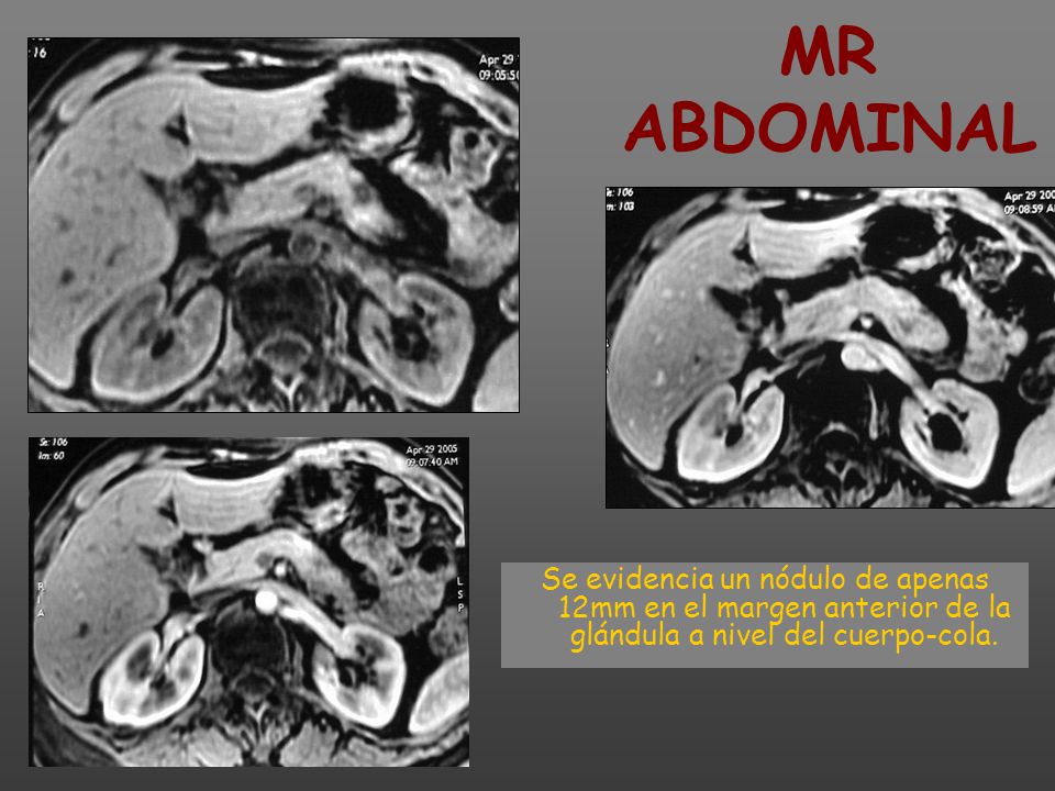 MR ABDOMINAL Se evidencia un nódulo de apenas 12mm en el margen anterior de la glándula a nivel del cuerpo-cola.