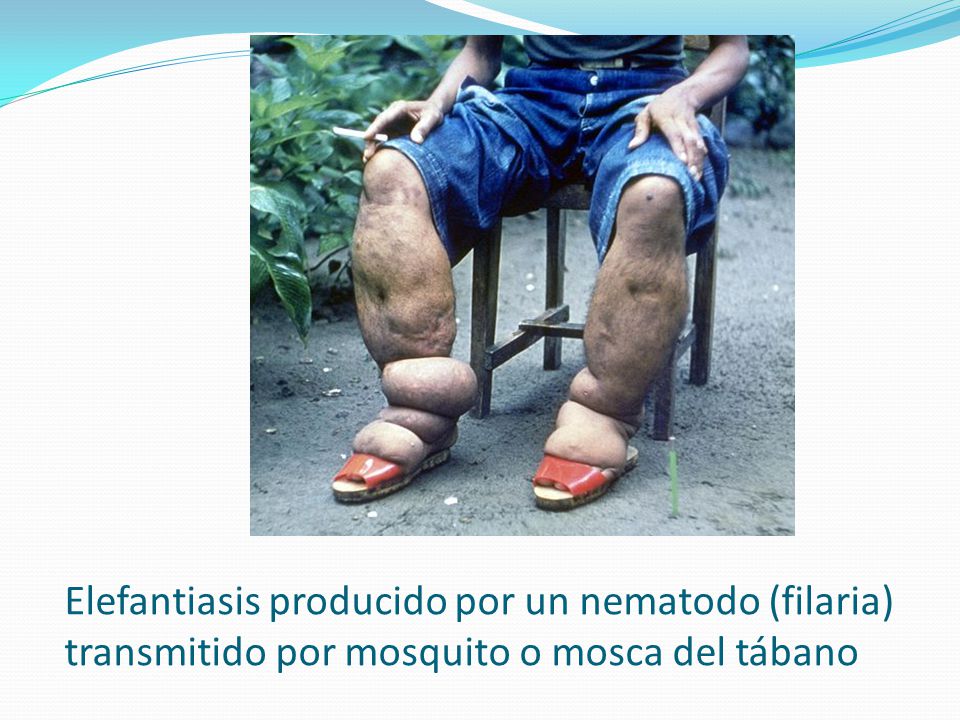 Elefantiasis producido por un nematodo (filaria) transmitido por mosquito o mosca del tábano