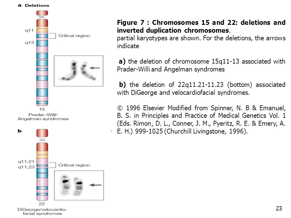Figure 7 : Chromosomes 15 and 22: deletions and inverted duplication chromosomes.