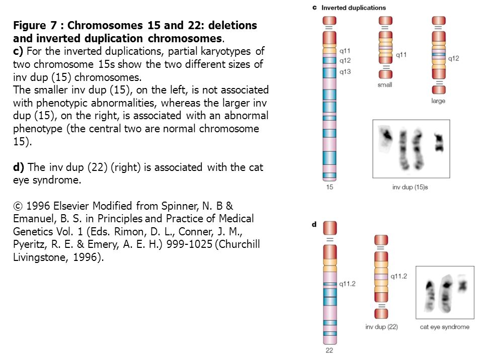 Figure 7 : Chromosomes 15 and 22: deletions and inverted duplication chromosomes.