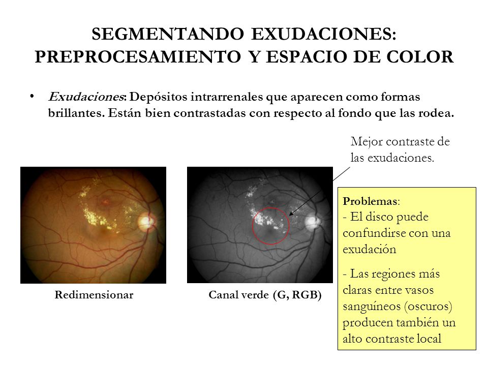 SEGMENTANDO EXUDACIONES: PREPROCESAMIENTO Y ESPACIO DE COLOR