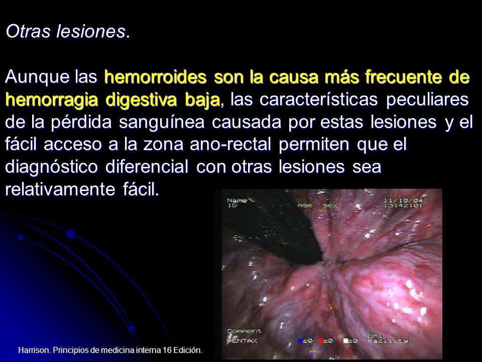 Aunque las hemorroides son la causa más frecuente de
