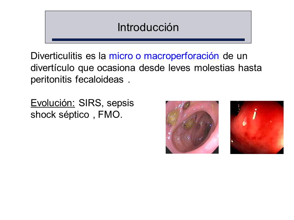 Introducción Diverticulitis es la micro o macroperforación de un