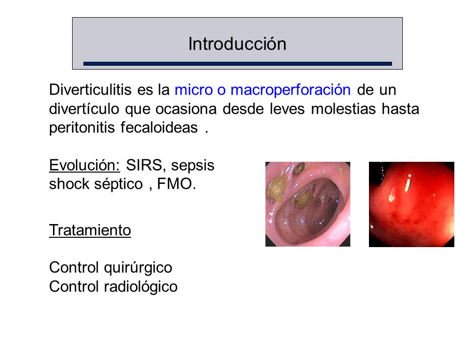 Introducción Diverticulitis es la micro o macroperforación de un
