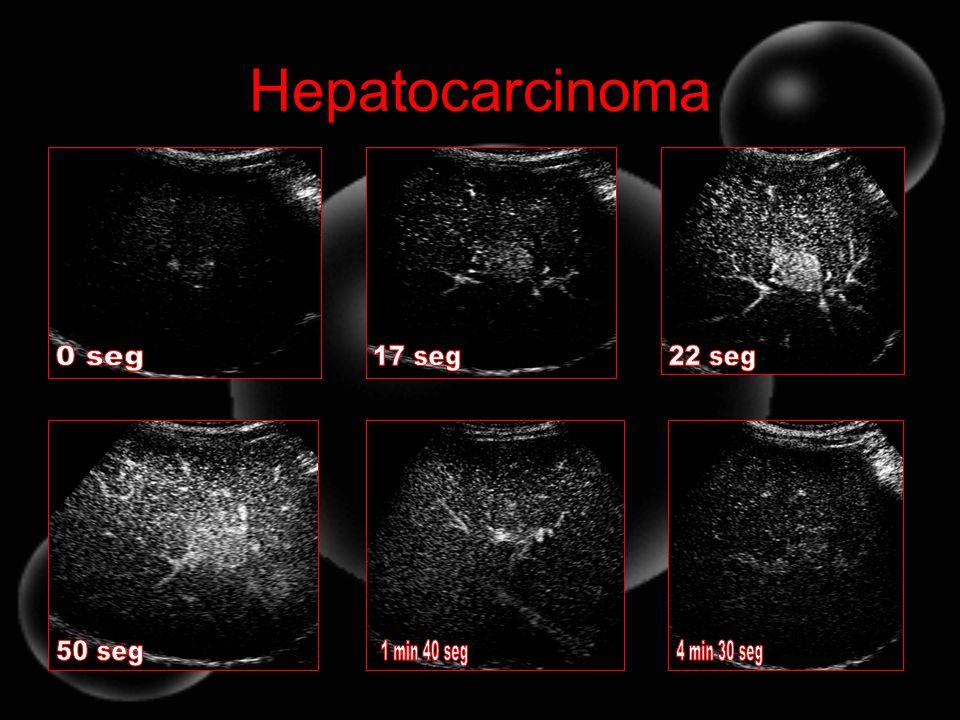 Hepatocarcinoma 0 seg 17 seg 22 seg 50 seg 1 min 40 seg 4 min 30 seg