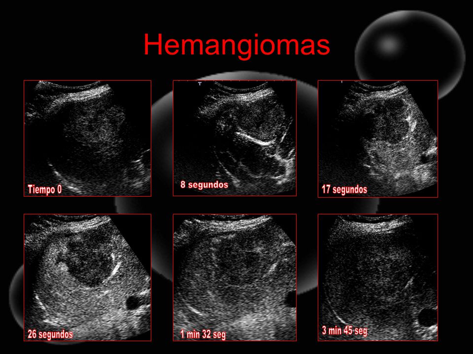 Hemangiomas 8 segundos Tiempo 0 17 segundos 3 min 45 seg 26 segundos