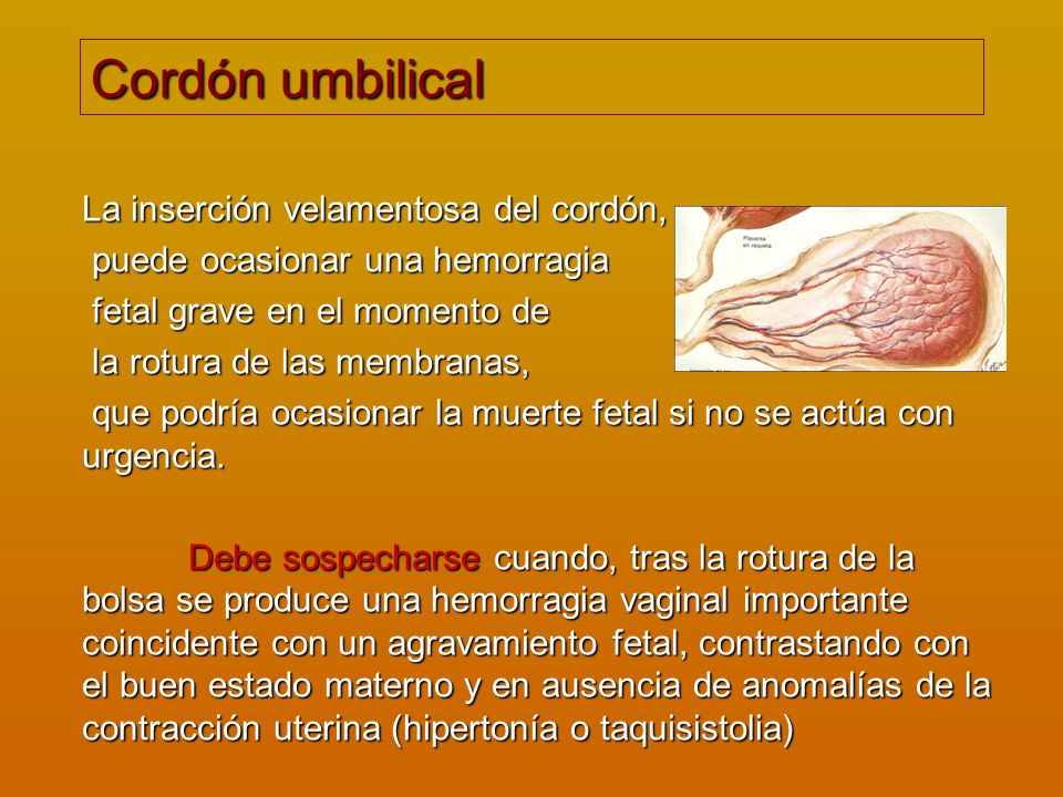 Cordón umbilical La inserción velamentosa del cordón,