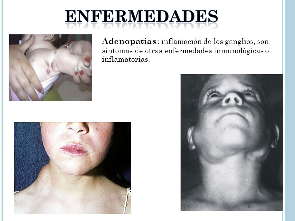enfermedades Adenopatías : inflamación de los ganglios, son síntomas de otras enfermedades inmunológicas o inflamatorias.