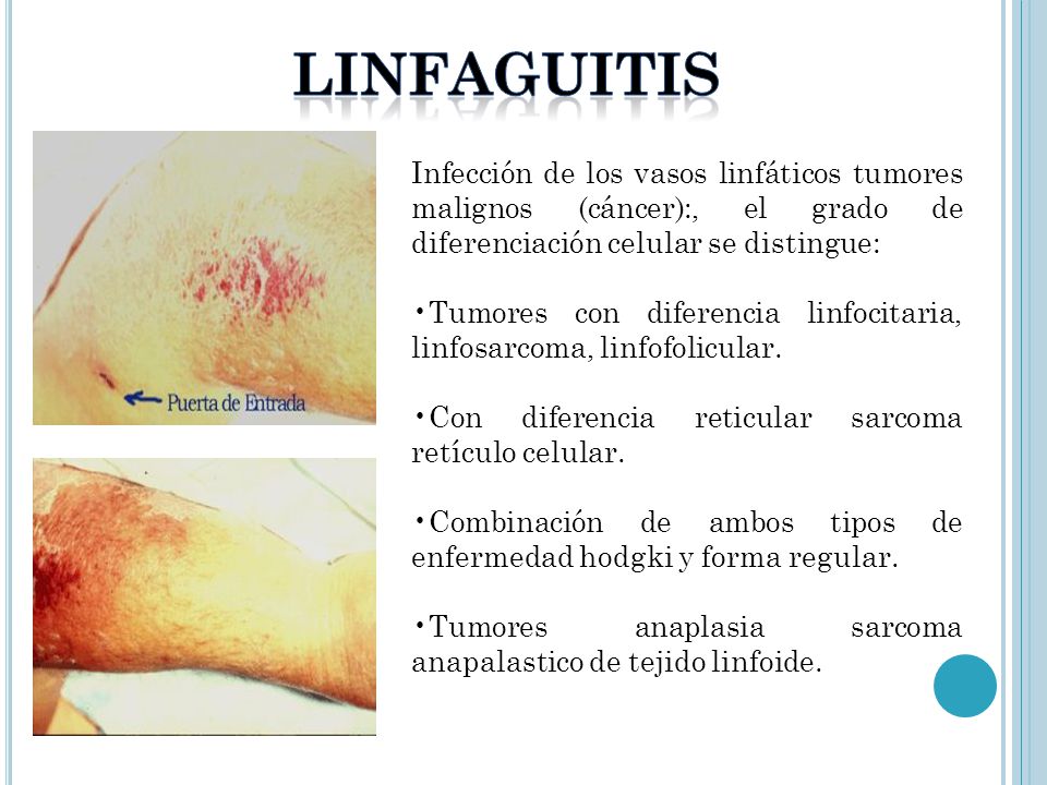 LINFAGUITIS Infección de los vasos linfáticos tumores malignos (cáncer):, el grado de diferenciación celular se distingue: