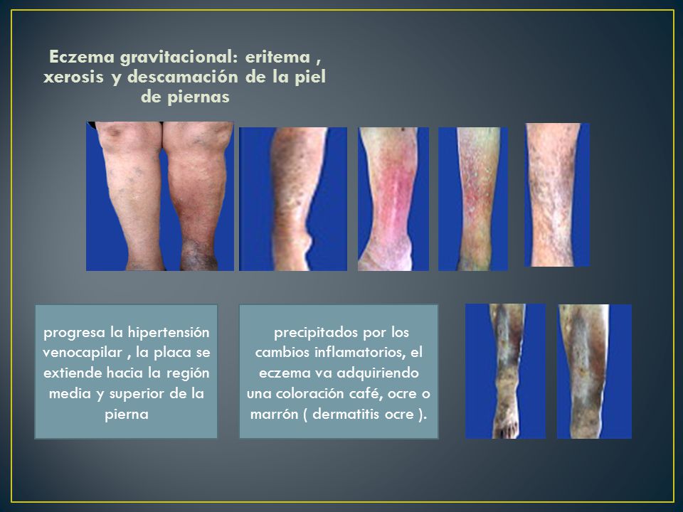 Eczema gravitacional: eritema , xerosis y descamación de la piel de piernas