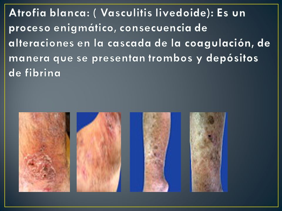 Atrofia blanca: ( Vasculitis livedoide): Es un proceso enigmático, consecuencia de alteraciones en la cascada de la coagulación, de manera que se presentan trombos y depósitos de fibrina
