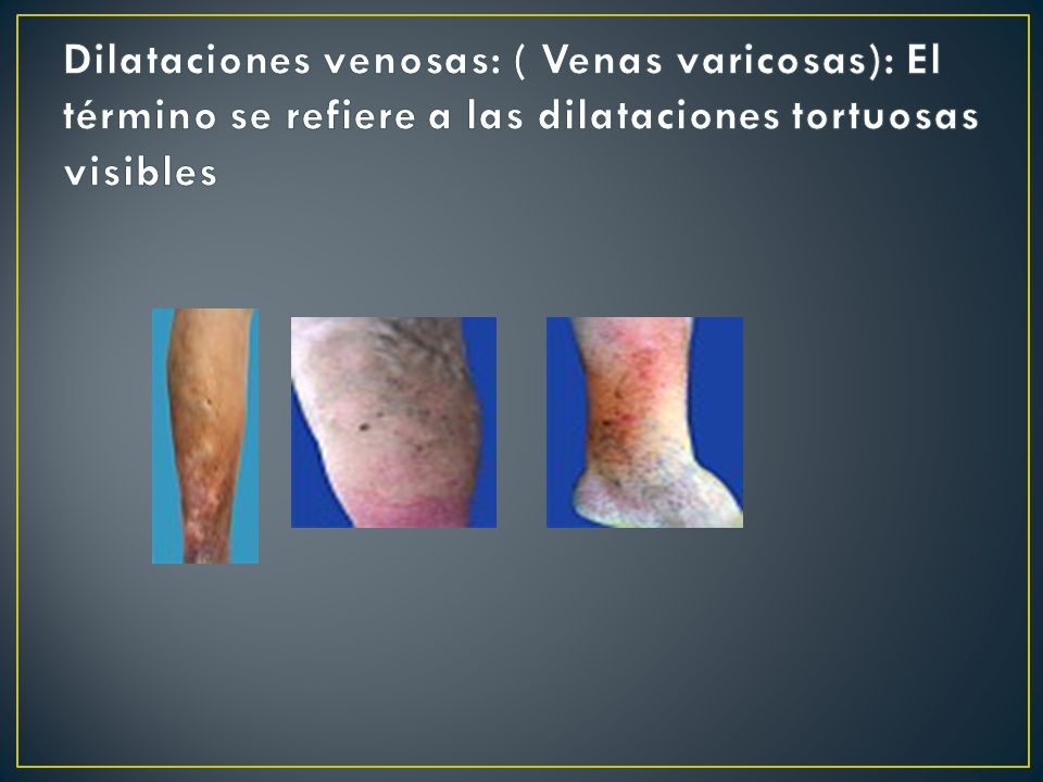 Dilataciones venosas: ( Venas varicosas): El término se refiere a las dilataciones tortuosas visibles