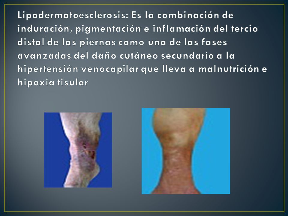 Lipodermatoesclerosis: Es la combinación de induración, pigmentación e inflamación del tercio distal de las piernas como una de las fases avanzadas del daño cutáneo secundario a la hipertensión venocapilar que lleva a malnutrición e hipoxia tisular