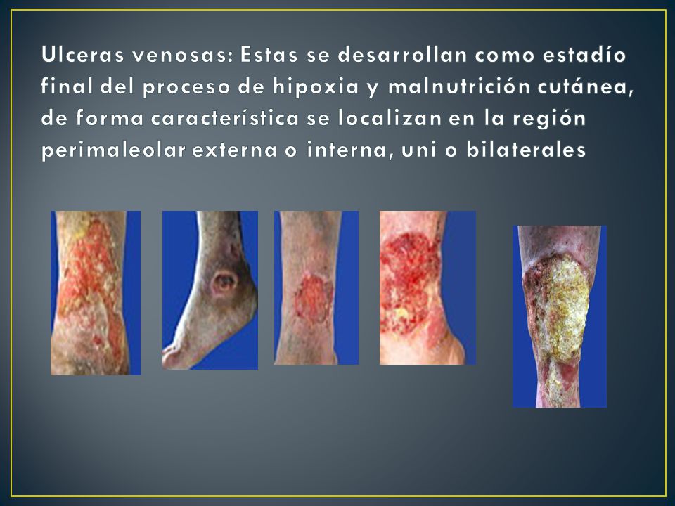Ulceras venosas: Estas se desarrollan como estadío final del proceso de hipoxia y malnutrición cutánea, de forma característica se localizan en la región perimaleolar externa o interna, uni o bilaterales