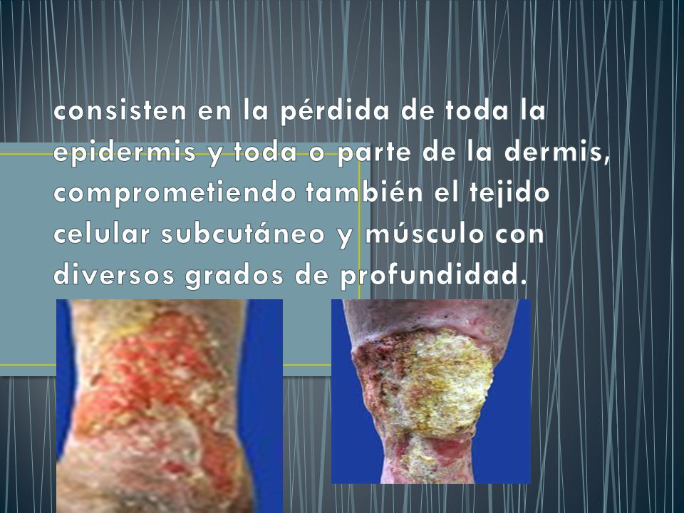 consisten en la pérdida de toda la epidermis y toda o parte de la dermis, comprometiendo también el tejido celular subcutáneo y músculo con diversos grados de profundidad.