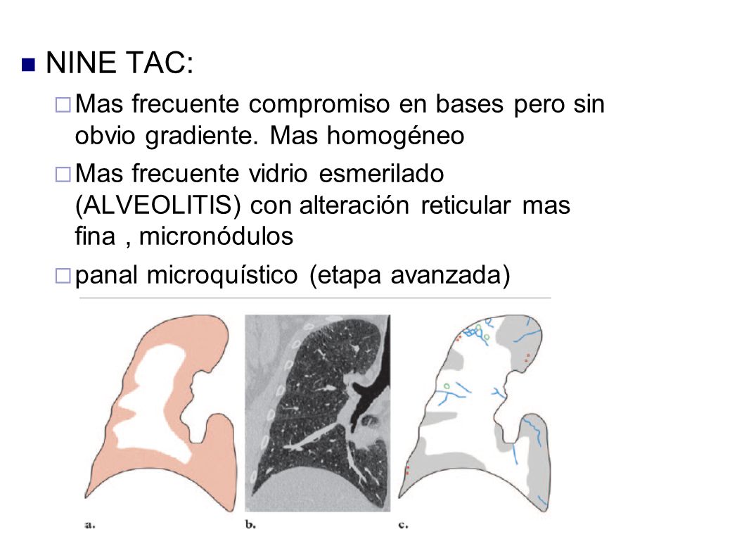 NINE TAC: Mas frecuente compromiso en bases pero sin obvio gradiente. Mas homogéneo.