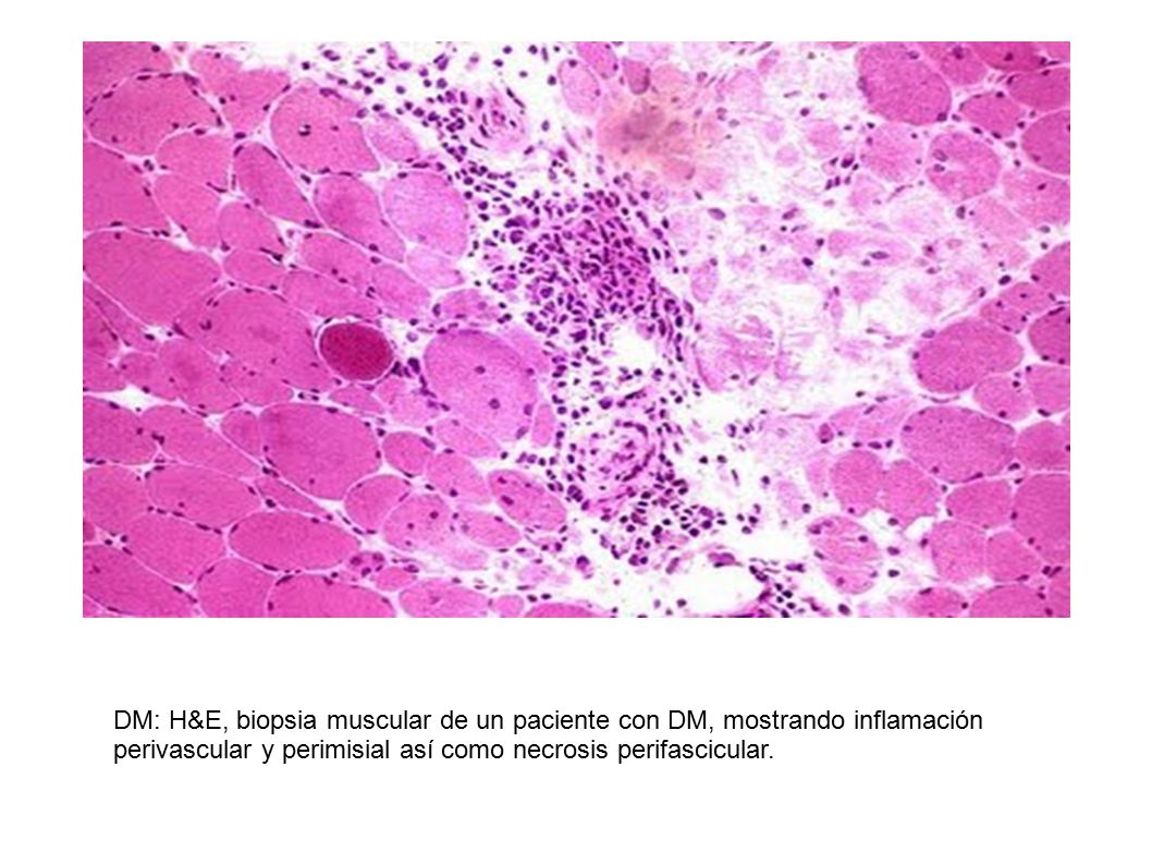 DM: H&E, biopsia muscular de un paciente con DM, mostrando inflamación perivascular y perimisial así como necrosis perifascicular.