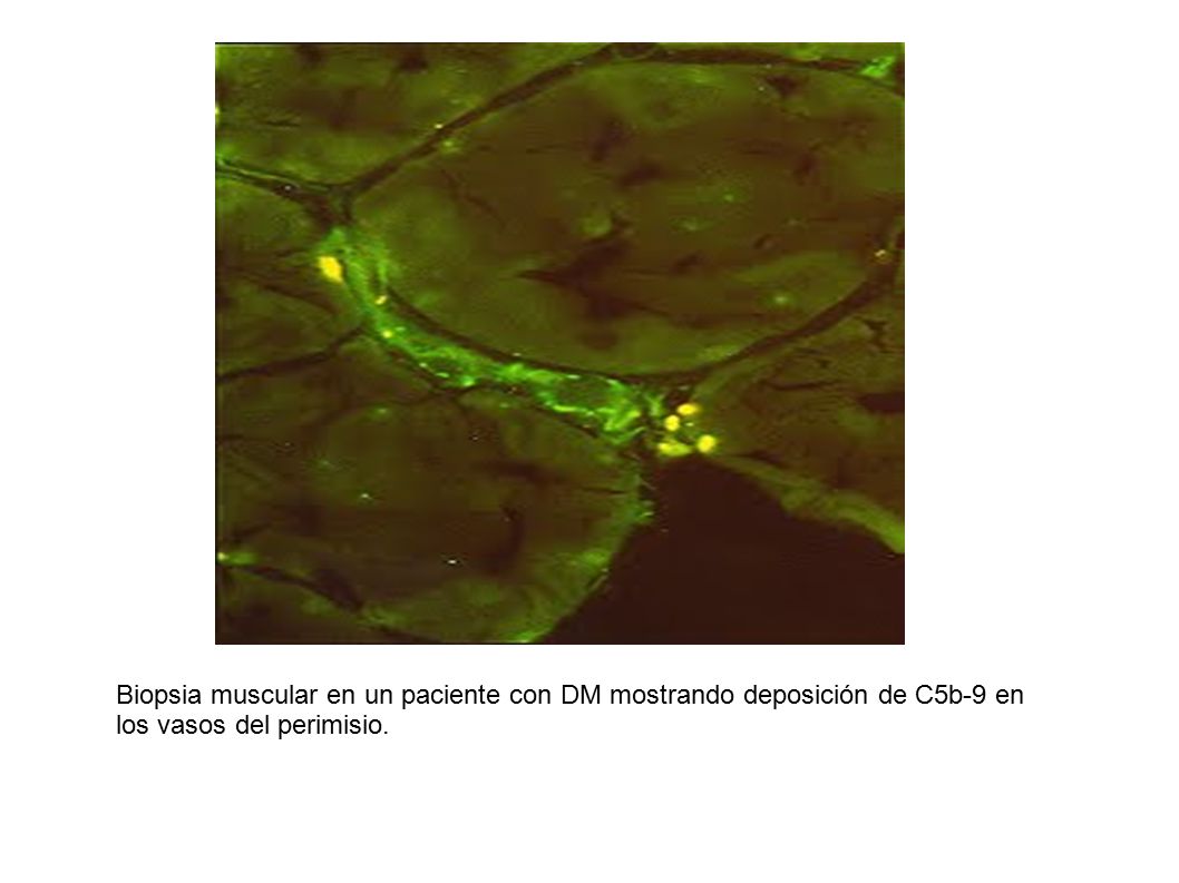 Biopsia muscular en un paciente con DM mostrando deposición de C5b-9 en los vasos del perimisio.