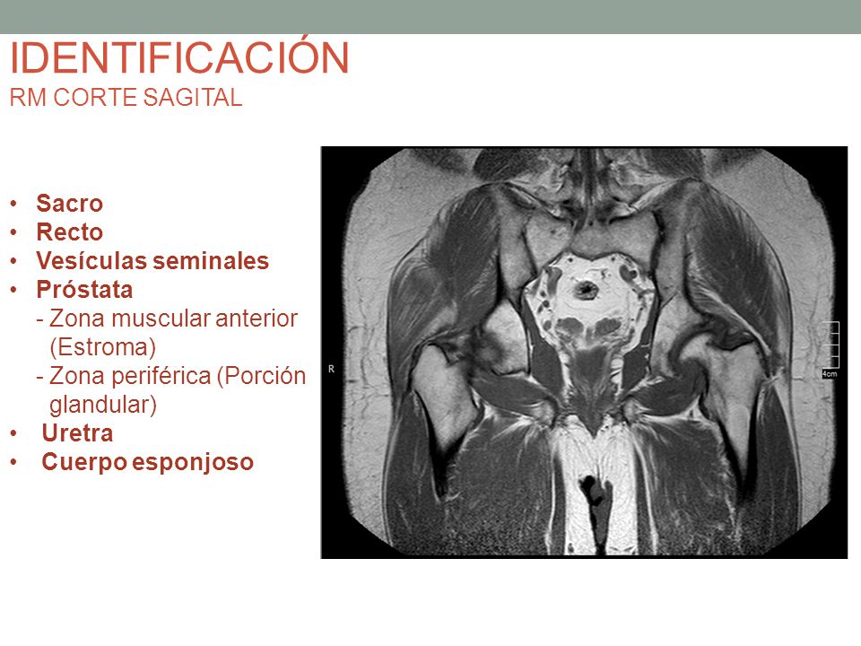 IDENTIFICACIÓN RM CORTE SAGITAL Sacro Recto Vesículas seminales