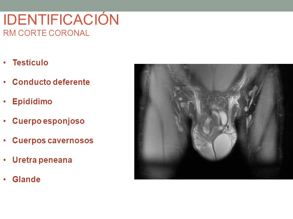 IDENTIFICACIÓN RM CORTE CORONAL Testículo Conducto deferente Epidídimo