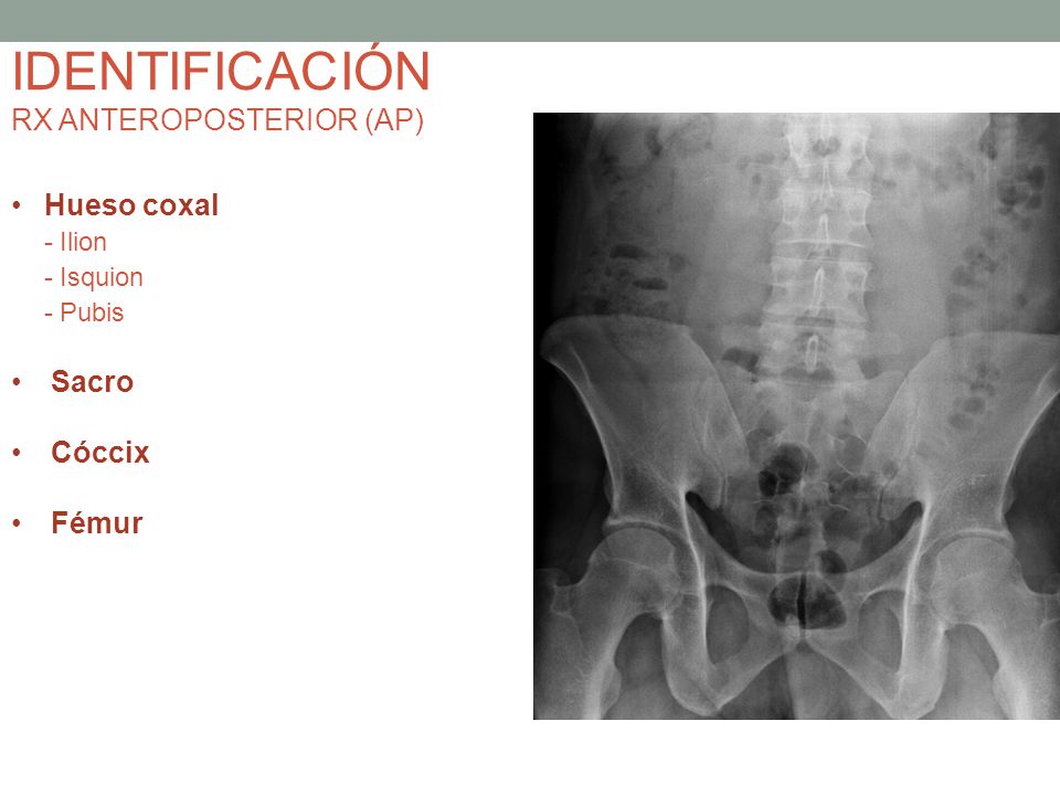 IDENTIFICACIÓN RX ANTEROPOSTERIOR (AP) Hueso coxal - Ilion - Isquion
