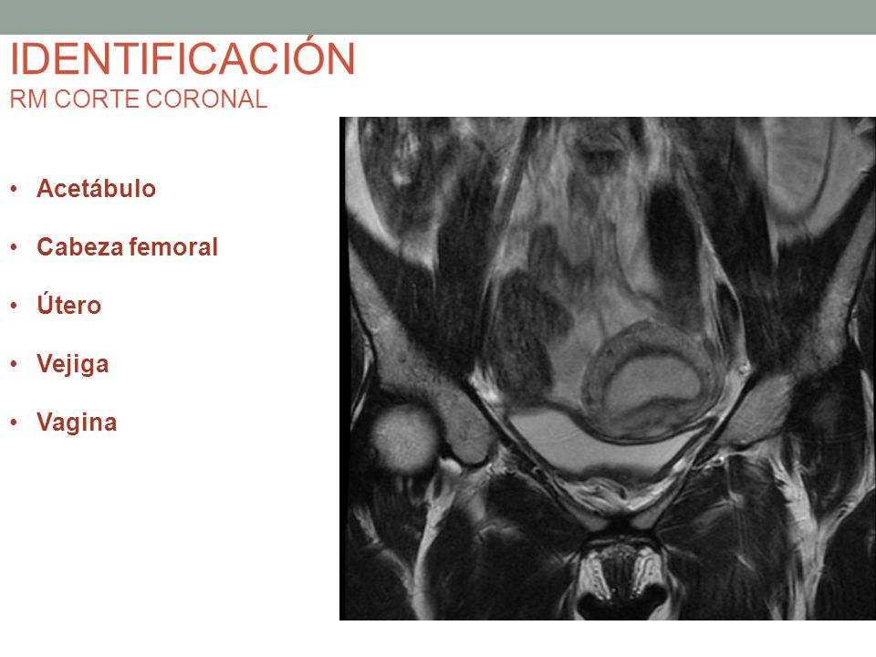 IDENTIFICACIÓN RM CORTE CORONAL Acetábulo Cabeza femoral Útero Vejiga
