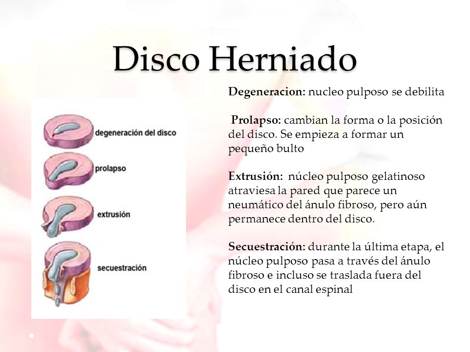Disco Herniado Degeneracion: nucleo pulposo se debilita