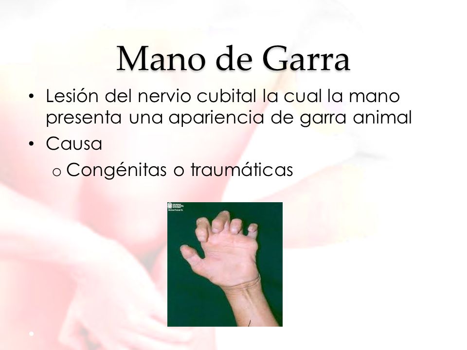 Mano de Garra Lesión del nervio cubital la cual la mano presenta una apariencia de garra animal. Causa.