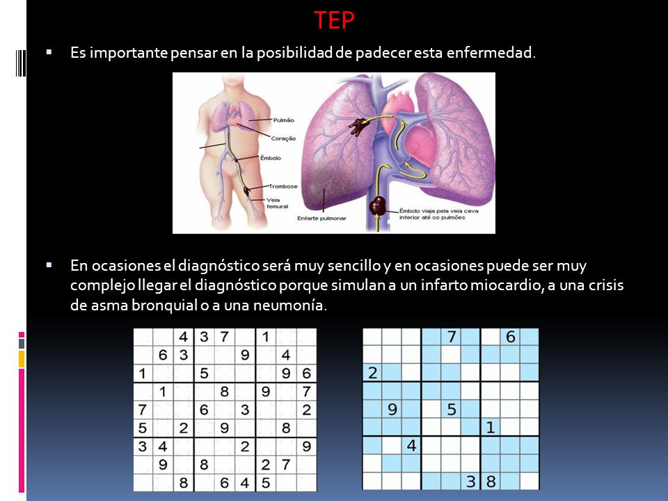 TEP Es importante pensar en la posibilidad de padecer esta enfermedad.