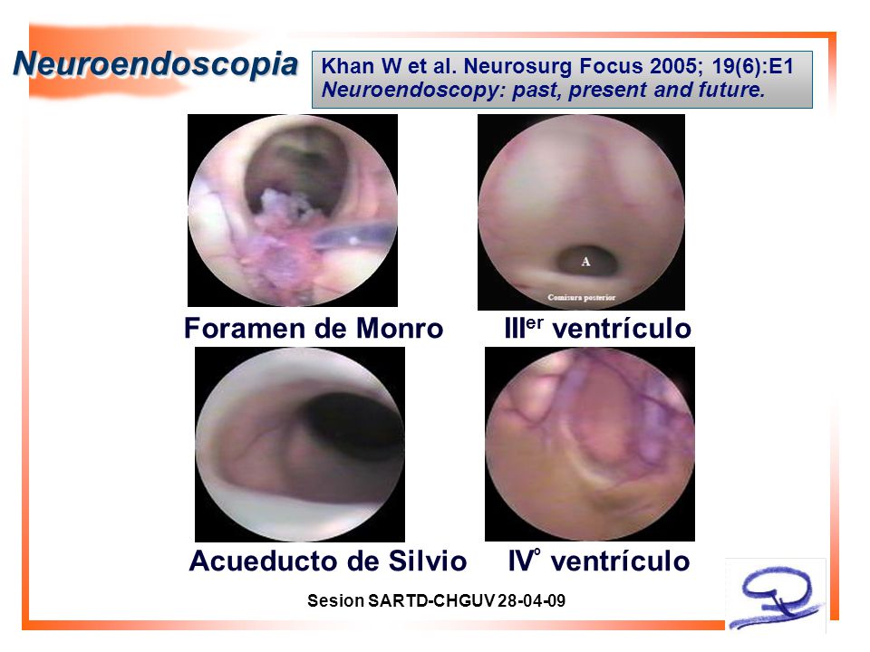 Neuroendoscopia Foramen de Monro IIIer ventrículo Acueducto de Silvio