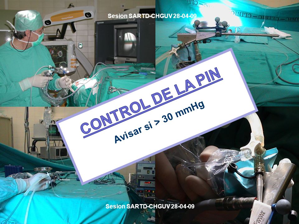 CONTROL DE LA PIN Avisar si > 30 mmHg Sesion SARTD-CHGUV