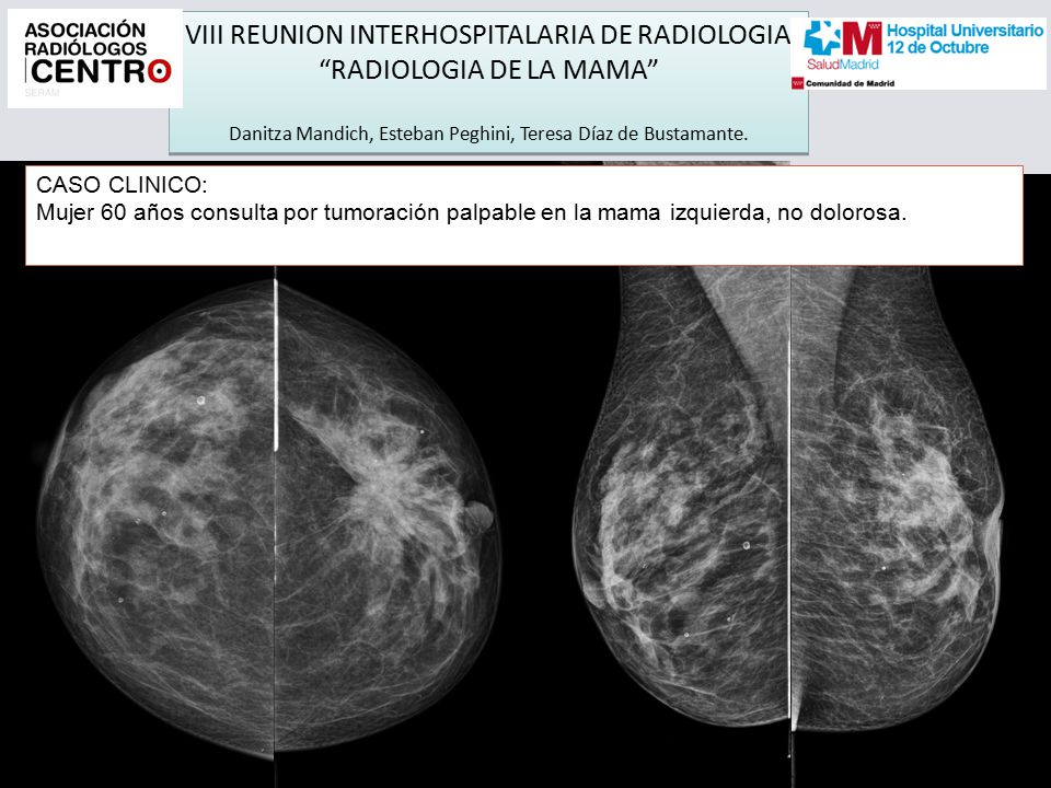 VIII REUNION INTERHOSPITALARIA DE RADIOLOGIA RADIOLOGIA DE LA MAMA Danitza Mandich, Esteban Peghini, Teresa Díaz de Bustamante.