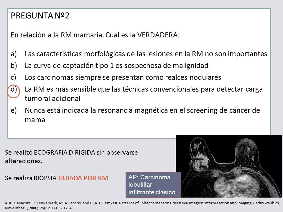 PREGUNTA Nº2 En relación a la RM mamaria. Cual es la VERDADERA: